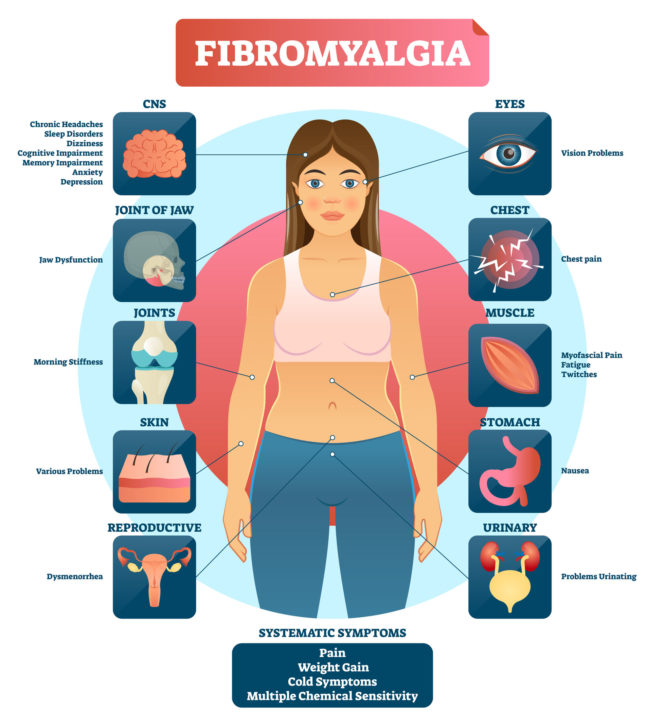 version anglophone du graphique des symptômes de la fibromyalgie